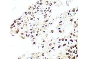 Immunohistochemistry of paraffin-embedded Human lung cancer using HIRA Polyclonal Antibody at dilution of 1:100 (40x lens).