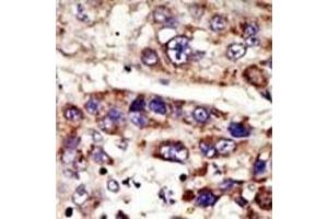 Formalin-fixed and paraffin-embedded human cancer tissue reacted with the primary antibody, which was peroxidase-conjugated to the secondary antibody, followed by DAB staining. (ZMPSTE24 抗体  (C-Term))