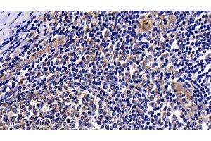 Detection of PKBa in Human Amygdalitis Tissue using Polyclonal Antibody to Protein Kinase B Alpha (PKBa) (AKT1 抗体  (AA 122-443))