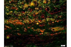 Formalin-fixed and paraffin-embedded human lung labeled with Anti-IL-2R gamma Polyclonal Antibody, Unconjugatedused at 1:200 dilution for 40 minutes at 37°C. (IL2RG 抗体  (AA 51-150))