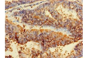 Immunohistochemistry of paraffin-embedded human endometrial cancer using ABIN7153928 at dilution of 1:100 (GPI 抗体  (AA 2-554))