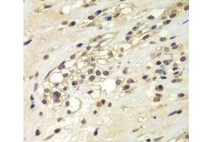 Immunohistochemistry of paraffin-embedded Human kidney cancer using CHEK1 Polyclonal Antibody at dilution of 1:100 (40x lens). (CHEK1 抗体)