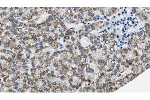 ABIN6275941 at 1/100 staining Human liver cancer tissue by IHC-P. (PTGER3 抗体  (C-Term))