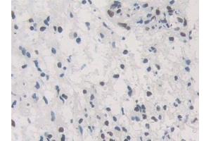 Detection of HNRNPA1 in Human Glioma Tissue using Polyclonal Antibody to Heterogeneous Nuclear Ribonucleoprotein A1 (HNRNPA1) (HNRNPA1 抗体  (AA 2-372))