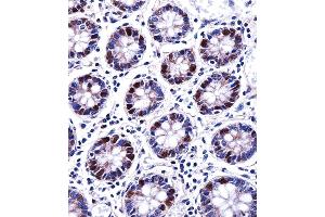 DUT Antibody immunohistochemistry analysis in formalin fixed and paraffin embedded human colon tissue followed by peroxidase conjugation of the secondary antibody and DAB staining. (Deoxyuridine Triphosphatase (DUT) (AA 170-198), (C-Term) 抗体)