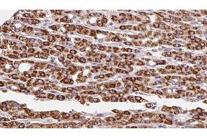 ABIN6272254 at 1/100 staining Human liver cancer tissue by IHC-P.