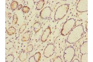 Immunohistochemistry of paraffin-embedded human colon cancer using ABIN7146794 at dilution of 1:100 (CEACAM4 抗体  (AA 36-155))