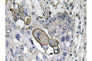 Immunohistochemical analysis of paraffin-embedded human lung cancer tissue using AQP5 polyclonal antibody . (Aquaporin 5 抗体)