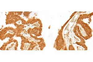 Immunohistochemistry of paraffin-embedded Human thyroid cancer tissue using GANC Polyclonal Antibody at dilution of 1:55(x200) (GANC 抗体)