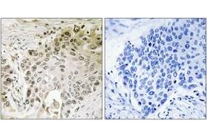 Immunohistochemistry analysis of paraffin-embedded human lung carcinoma, using RFX2 Antibody. (RFX2 抗体  (AA 661-710))
