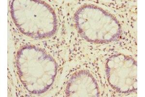 Immunohistochemistry of paraffin-embedded human colon cancer using ABIN7159601 at dilution of 1:100 (MSRB2 抗体  (AA 10-182))