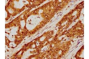 IHC image of nme1HU diluted at 1:5 and staining in paraffin-embedded human colon cancer performed on a Leica BondTM system. (Histone H2B 抗体  (AA 76-87))