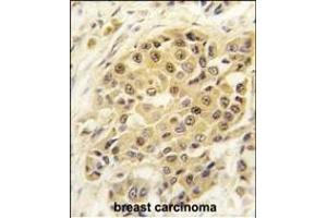 Formalin-fixed and paraffin-embedded human breast carcinoma tissue reacted with SENP3 antibody (N-term) (ABIN388047 and ABIN2845593) , which was peroxidase-conjugated to the secondary antibody, followed by DAB staining. (SENP3 抗体  (N-Term))