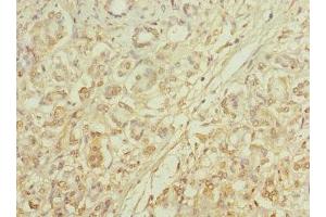 Immunohistochemistry of paraffin-embedded human pancreatic cancer using ABIN7146098 at dilution of 1:100 (MRC2 抗体  (AA 120-300))