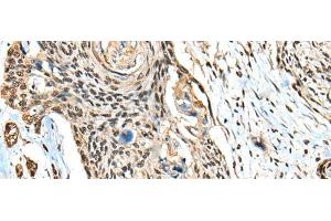 Immunohistochemistry of paraffin-embedded Human esophagus cancer tissue using CBFB Polyclonal Antibody at dilution of 1:40(x200) (CBFB 抗体)
