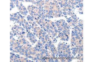 Immunohistochemistry of Human liver cancer using KCNH8 Polyclonal Antibody at dilution of 1:50 (KCNH8 抗体)