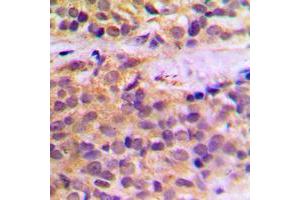 Immunohistochemical analysis of RAB11FIP1 staining in human prostate cancer formalin fixed paraffin embedded tissue section. (RAB11FIP1 抗体  (N-Term))