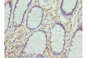 Immunohistochemistry of paraffin-embedded human colon cancer using ABIN7149288 at dilution of 1:100 (Cytohesin 2 抗体  (AA 150-350))