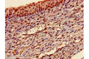 Immunohistochemistry of paraffin-embedded human ovarian cancer using ABIN7172847 at dilution of 1:100 (Transgelin 抗体  (AA 2-201))