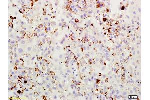 Formalin-fixed and paraffin embedded mouse melanoma labeled with Rabbit Anti ABCB5 Polyclonal Antibody, Unconjugated (ABIN731933) at 1:200 followed by conjugation to the secondary antibody and DAB staining (ABCB5 抗体  (AA 841-883))