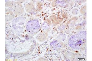 Formalin-fixed and paraffin embedded human lung carcinoma with labeled Anti-Properdin Polyclonal Antibody, Unconjugated (ABIN1386799) at 1:200, followed by conjugation to the secondary antibody and DAB staining (CFP 抗体  (AA 401-469))