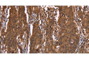 Immunohistochemistry of paraffin-embedded Human gastic cancer using HINT1 Polyclonal Antibody at dilution of 1:30 (HINT1 抗体)