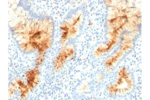 Formalin-fixed, paraffin-embedded human Gastric Carcinoma stained with MUC4 Mouse Monoclonal Antibody (MUC4/3105).