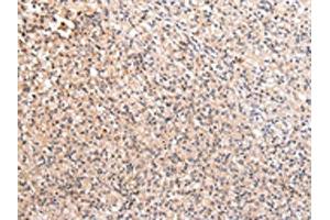 The image on the left is immunohistochemistry of paraffin-embedded Human prostate cancer tissue using ABIN7192170(RERE Antibody) at dilution 1/20, on the right is treated with synthetic peptide. (RERE 抗体)