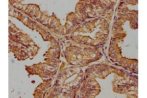 IHC image of ABIN7174401 diluted at 1:400 and staining in paraffin-embedded human prostate cancer performed on a Leica BondTM system. (ZRANB1 抗体  (AA 111-397))