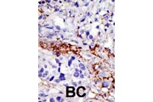 Formalin-fixed and paraffin-embedded human breast cancer tissue reacted with USP21 polyclonal antibody  , which was peroxidase-conjugated to the secondary antibody, followed by DAB staining. (USP21 抗体  (AA 406-436))
