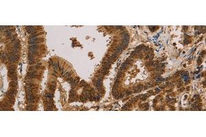 Immunohistochemistry of paraffin-embedded Human colon cancer tissue using CSNK2B Polyclonal Antibody at dilution of 1:30(x200) (CSNK2B 抗体)