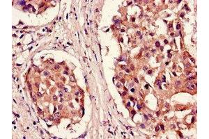 Immunohistochemistry of paraffin-embedded human breast cancer using ABIN7164982 at dilution of 1:100 (PSMB5 抗体  (AA 106-188))