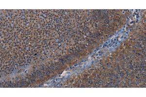 Immunohistochemistry of paraffin-embedded Human rectal cancer using P3H3 Polyclonal Antibody at dilution of 1:50 (LEPREL2 抗体)