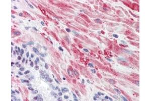 Immunohistochemistry with Anti-Glycogen Synthase antibody Tissue: Human Prostate Fixation: formalin-fixed, paraffin-embedded tissue Antigen retrieval: heat-induced Primary antibody: 5 µg/ml Staining: antibody as precipitated red signal with a hematoxylin purple nuclear counterstain. (Glycogen Synthase 1 抗体  (pSer641))