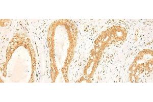 Immunohistochemistry of paraffin-embedded Human breast cancer tissue using ST8SIA4 Polyclonal Antibody at dilution of 1:50(x200) (ST8SIA4 抗体)