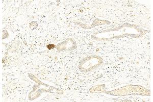(ABIN6255437) at 1/100 staining Human pancreatic cancer by IHC-P.
