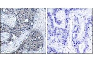 Immunohistochemistry analysis of paraffin-embedded human breast carcinoma, using eIF4E (Phospho-Ser209) Antibody. (EIF4E 抗体  (pSer209))