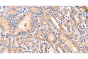 Immunohistochemistry of paraffin-embedded Human thyroid cancer tissue using CD109 Polyclonal Antibody at dilution 1:30 (CD109 抗体)