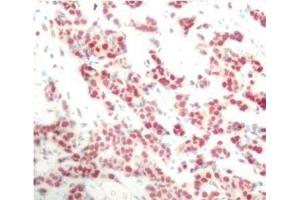 Immunohistochemistry of paraffin-embedded Human breast carcinoma using Phospho-NFkB p100(S866) Polyclonal Antibody (NFKB2 抗体  (pSer866))