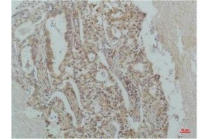 Immunohistochemistry (IHC) analysis of paraffin-embedded Human Lung Carcinoma using IkappaB beta(Monoclonal Antibody diluted at 1:200. (NFKBIB 抗体)