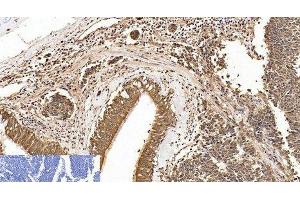 Immunohistochemistry of paraffin-embedded Human lung cancer tissue using Cleaved-PARP1 (D214) Polyclonal Antibody at dilution of 1:200. (PARP1 抗体  (Cleaved-Asp214))