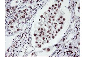Immunohistochemical staining of paraffin-embedded Carcinoma of Human lung tissue using anti-RNF113B mouse monoclonal antibody. (RNF113B 抗体)