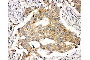 IHC-P: Prolactin Receptor antibody testing of human breast cancer tissue (Prolactin Receptor 抗体  (C-Term))
