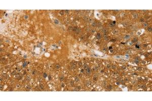 Immunohistochemistry of paraffin-embedded Human breast cancer using TBC1D4 Polyclonal Antibody at dilution of 1:40 (TBC1D4 抗体)