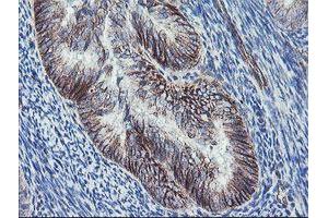 Immunohistochemical staining of paraffin-embedded Adenocarcinoma of Human endometrium tissue using anti-DTNB mouse monoclonal antibody. (Dystrobrevin beta 抗体)