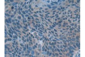 IHC-P analysis of Human Esophagus cancer Tissue, with DAB staining. (Acetylcholinesterase 抗体  (AA 366-554))