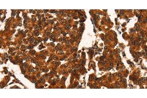 Immunohistochemistry of paraffin-embedded Human breast cancer using CUEDC2 Polyclonal Antibody at dilution of 1:50 (CUEDC2 抗体)