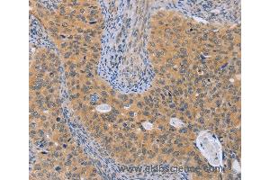 Immunohistochemistry of Human cervical cancer using BRS3 Polyclonal Antibody at dilution of 1:50 (BRS3 抗体)
