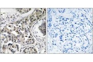 Immunohistochemistry analysis of paraffin-embedded human breast carcinoma, using USP6NL Antibody. (USP6NL 抗体  (AA 451-500))