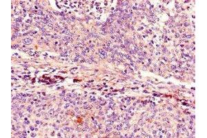 Immunohistochemistry of paraffin-embedded human cervical cancer using  at dilution of 1:100 (CDKN2A 抗体  (AA 1-86))